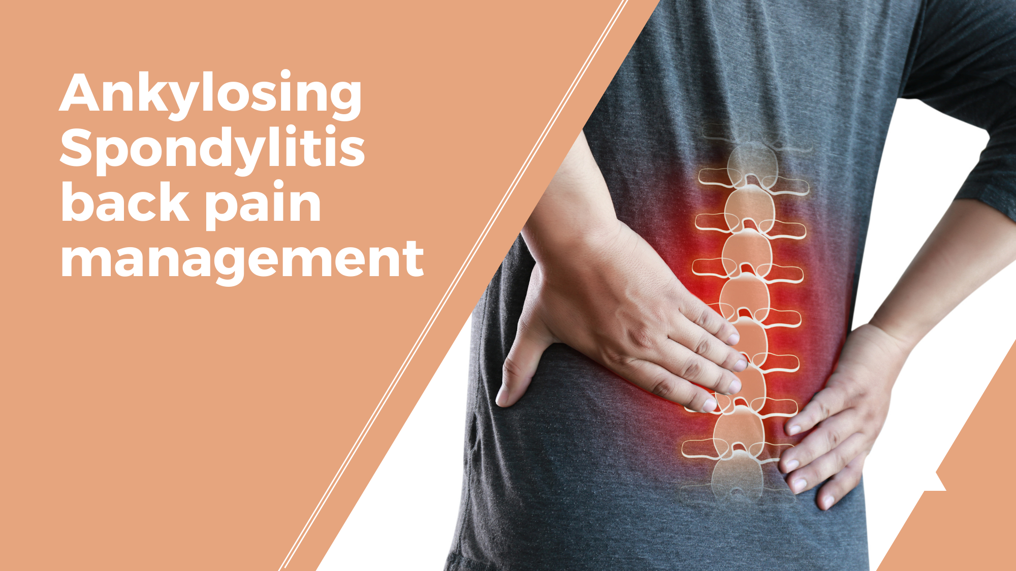 Ankylosing Spondylitis back pain management
